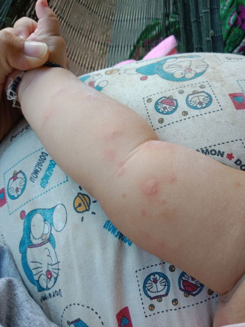 สอบถามน้องเป็นลมพิษไหมคะ