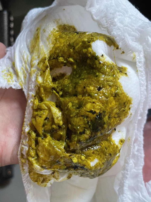 สีถ่ายลูกน้อยผิดปกติ