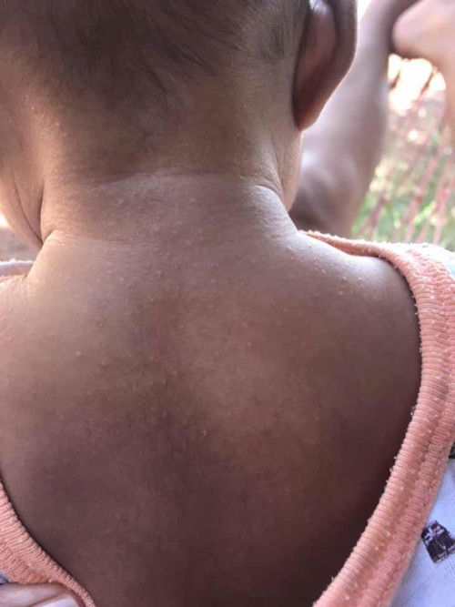 แบบนี้เขาเรียกผื่นอะไรคะ