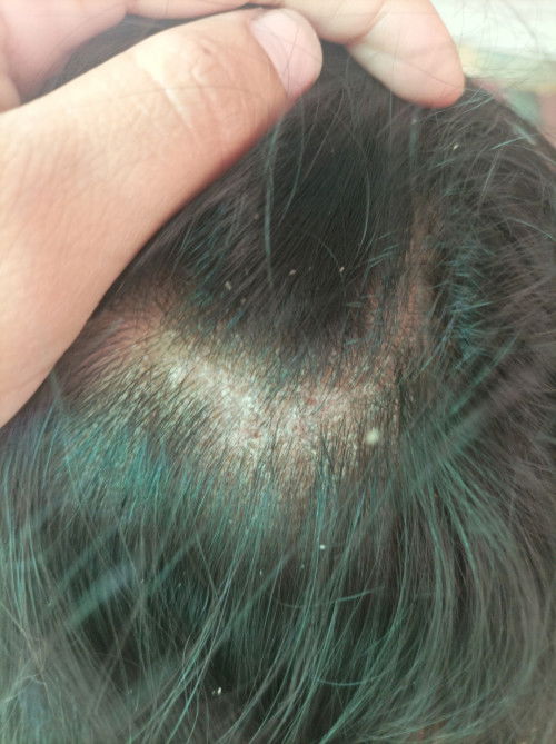 หนังหัวเหมือนรังเเค มีอาการคัน