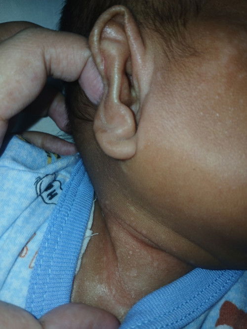 Ruam pada wajah dan leher