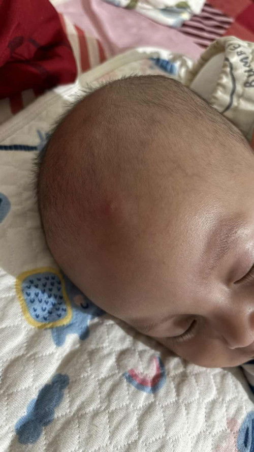 Bisul pada bayi 8 bulan