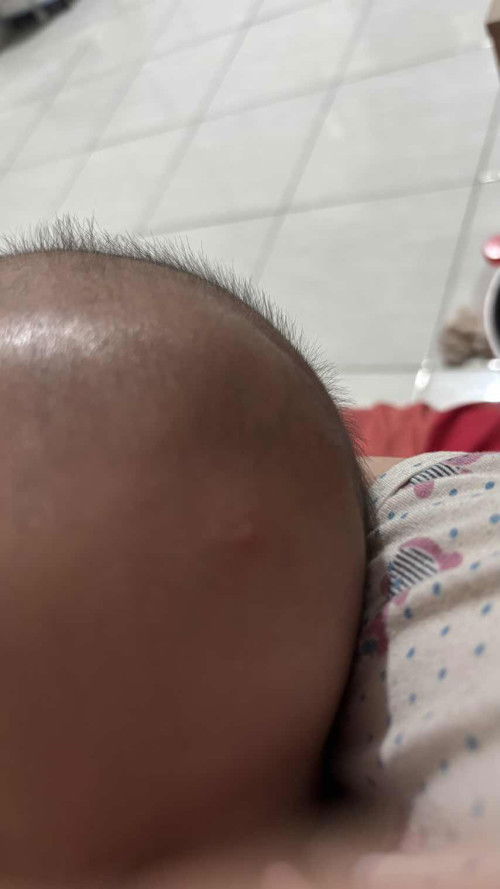 Bisul pada bayi 8 bulan