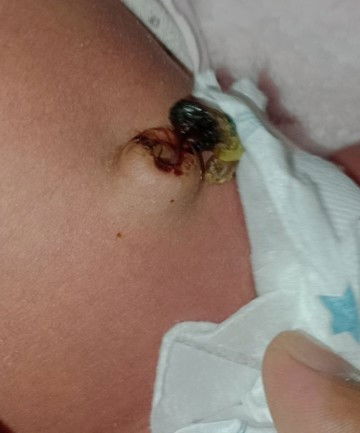 สะดือลูกแบบนี้ปกติมั้ยคะ