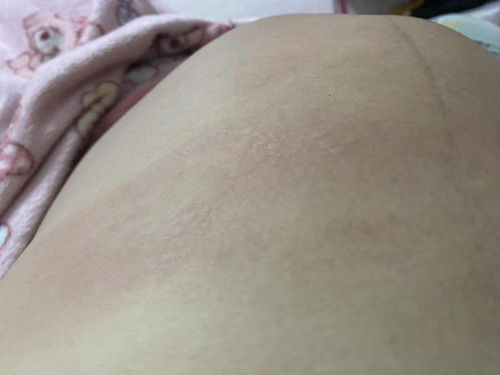 ผื่นคันตามตัวและหน้าท้อง
