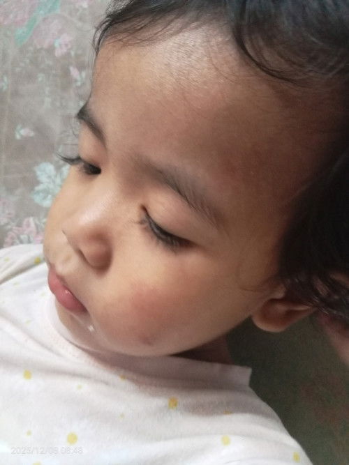 Kulit sensitif atau alergi