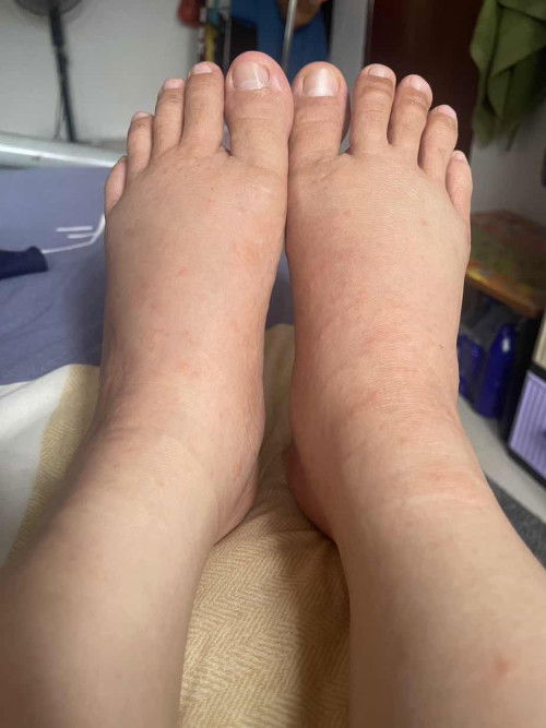 Naik biji2 gatal 3rd trimester #ftm