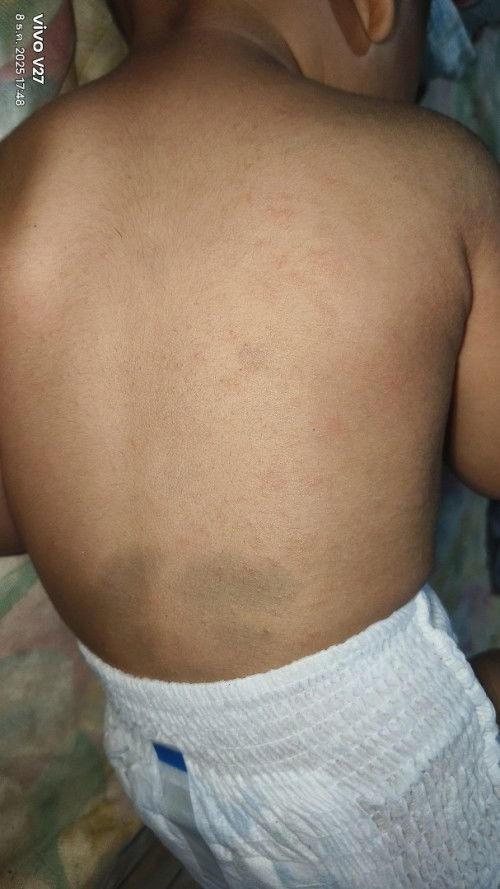 แบบนี้เรียกผื่นอะไรค่ะ