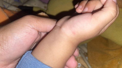 Benjolan pada pergelangan tangan