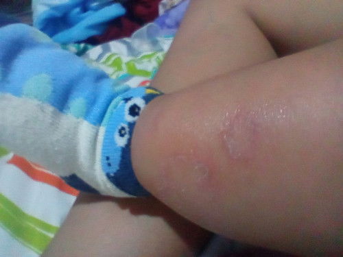Rashes 5mo old