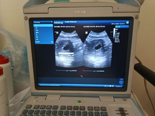 Hamil 10minggu tapi kelihatan kantong aja.