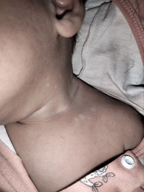 Bercak putih di area leher bayi