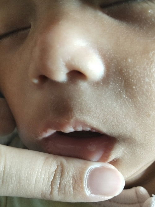 ร้อนในเด็ก 2 เดือน 21 วัน