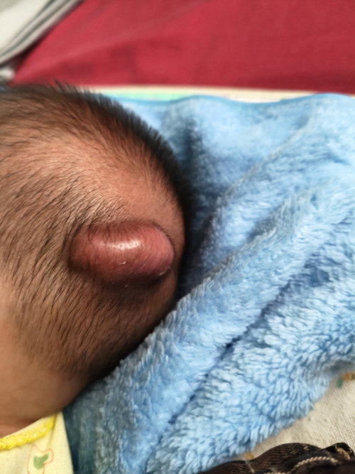 Benjol Di kepala bayi 1 bulan