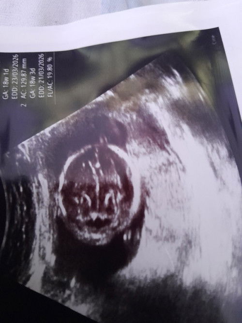 อยากสอบถามแม่ๆๆแบบนี้เป็นปากแหว่งเพดานโหว่ไหมคะ