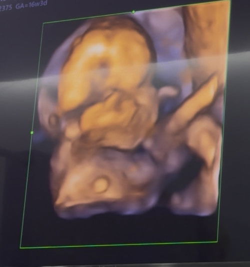 Apakah posisi bayinya masih sembunyi kalau sperti ini ?