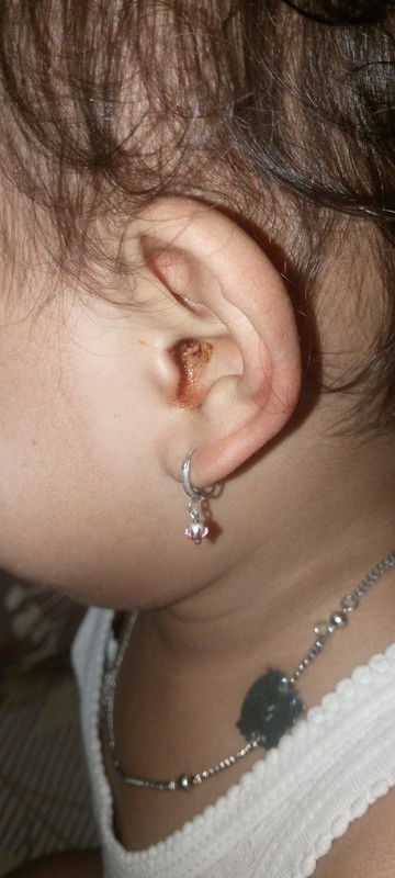 Telinga Anak berdarah