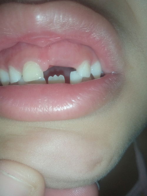 Asking lang mga mommies  tutubo pa kaya teeth ng anak ko 6yrs old?