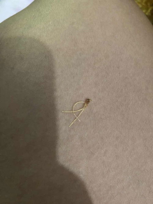 คลอดธรรมชาติไหมไม่ละลาย