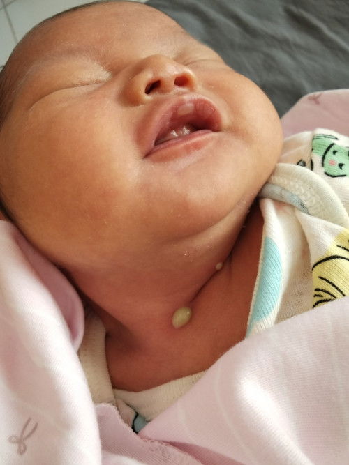 bintik bernanah di kulit bayi