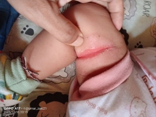 Lecet di lipatan lipatan badan