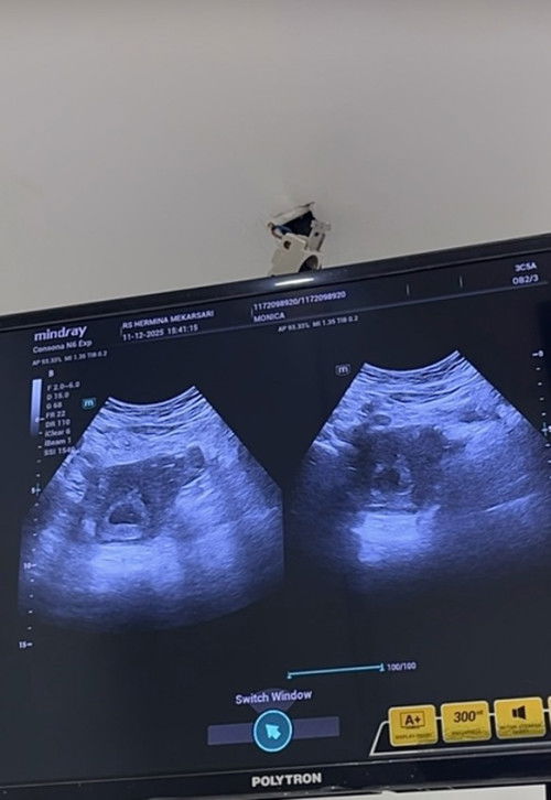 Hai bundaaaa usg 5minggu 3 hari