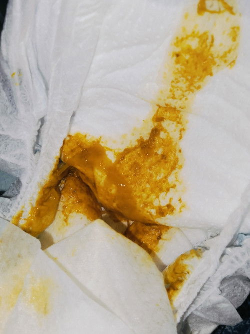 อึเหมือนเป็นมูกใส 2 เดือน 23 วัน