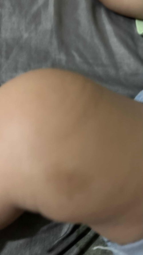 Bekas bentol yg sudah hitam