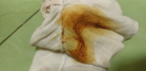 ท้องเสียถ่ายเป็นน้ำได้5วันแล้ว วันนี้น◌้องถ่ายปนเลือดแบบนี้