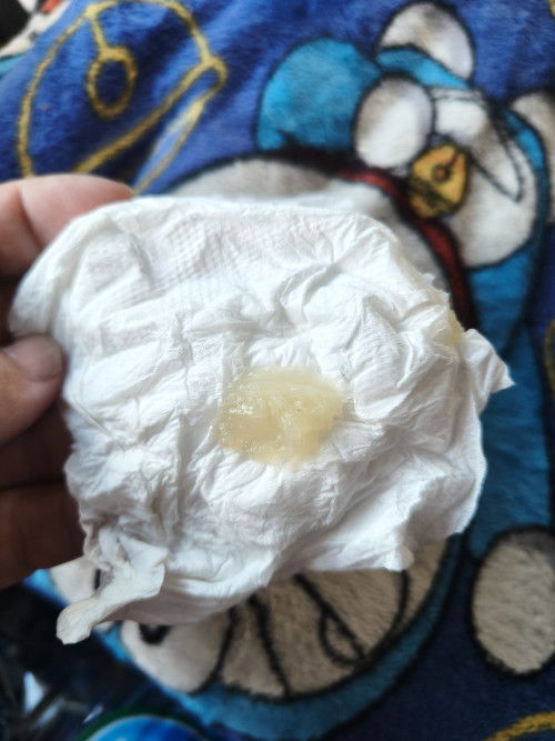 มูกใสแบบนี้เราต้องไปรพ.เลยมั๊ยคะ