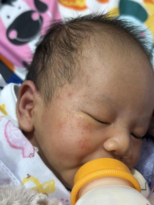 น้อง 29 วัน
มีผื่นแบบนี้ขึ้นที่หน้าเยอะและบนหัวน้องด้วยค่ะ