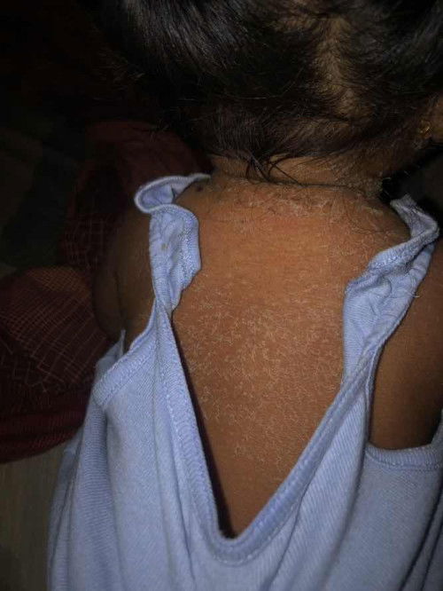 Allergy? Hello po sino po nka experience ng gnito kay baby?