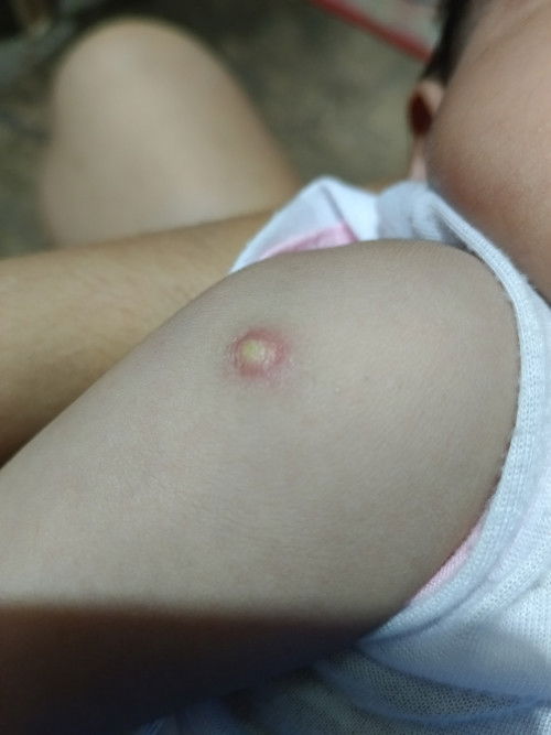 vaccine lump
