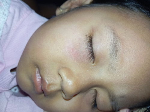 tiba2 beruntusan kadang ada merahnya tapi tidak gatal hanyang sebelah dan diarea mata