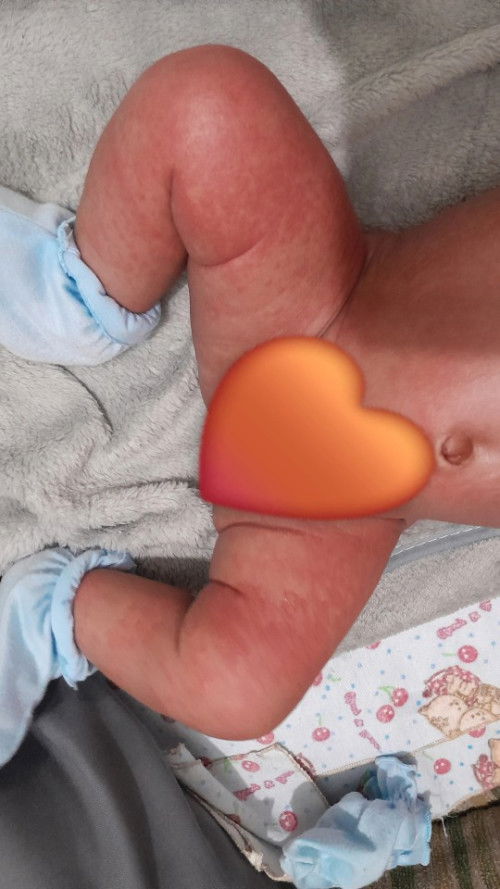 Merah merah di badan bayi