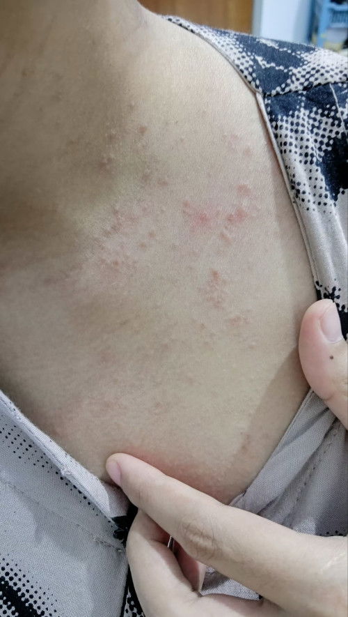 Bunda obat buat gatel kek gini saat hamil apa ya yg manjur. Aku kasih kaladin ga mempan