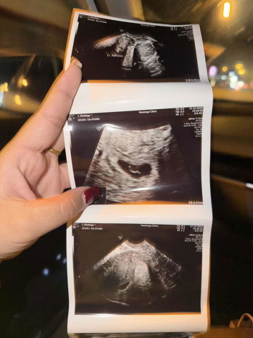 7weeksเจอถุงไข่แดงยังไม่เจอตัวน้องปกติไหมค่ะ⁉️