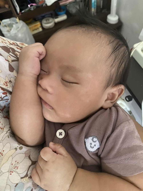 Tratakan/Bercak Putih Pada Wajah Bayi