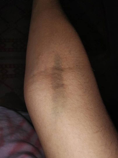 34 w อยากรู้แม่ๆ บ้านไหนบ้าง ตั้งแต่ตัครรภ์มา โดนเจาะเลือดไปกี่เข็มแล้ว