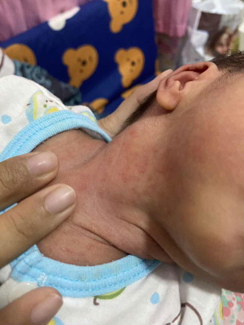 เป็นผื่นหรืออะไรคะแม่ๆ