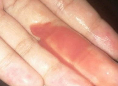 ท้อง38วีคมีตกขาวแบบนี้