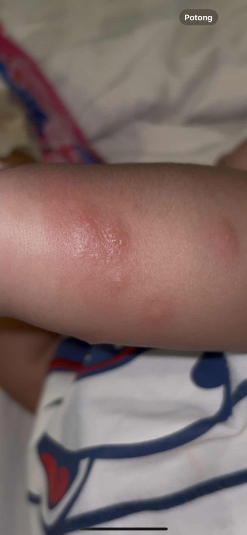 Bayi bentol berisi air