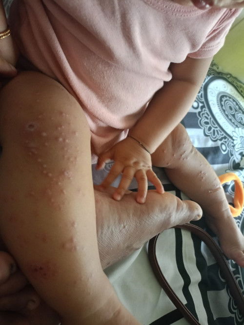 Ini kenapa ya bunda padahal anak saya tidak ada riwayat alergi sudah 2 hari begini