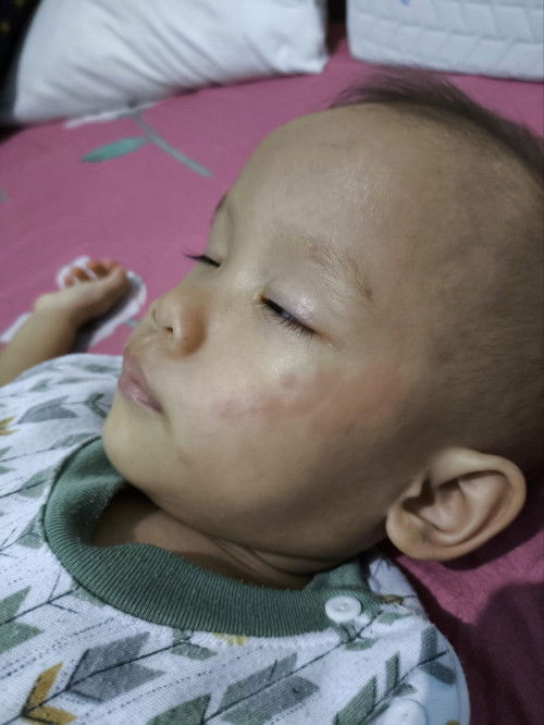 Merah" pda kulit anak