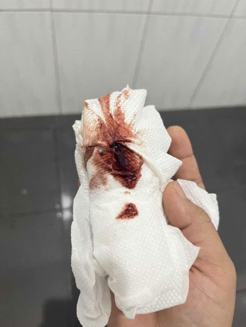 สอบถามหน่อยค่ะแม่ๆหนูตรวจฉี่ขึ้น2ขีดเข้ม ตรวจเลือดก้เจอค่าHCG แต่ซาวยังไม่เจอถุงตั้งครรภ์ แต่เมื่อวานหนูมีเลือดออกแบบนี้คือ..มั้ยคะ