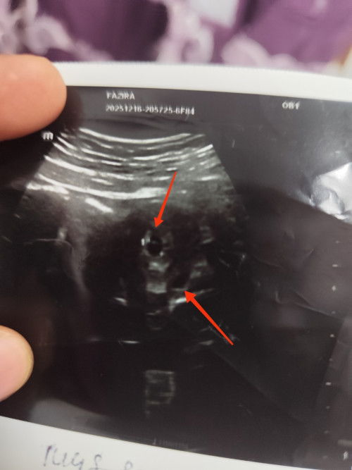 Adakah itu kembar?sy scan semlm....dokter pon x pasti...boleh mommy bgi pendapat..?