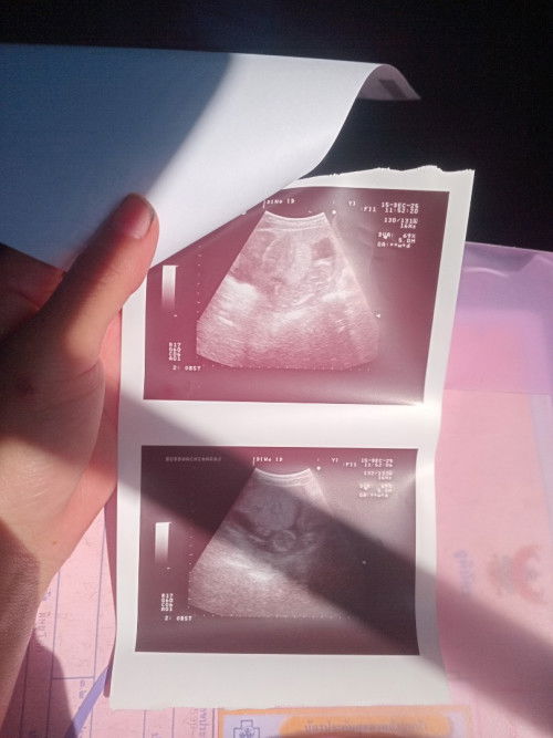 ลูกไม่สมบูรณ์และลูกตายอยู่ในท้อง😔