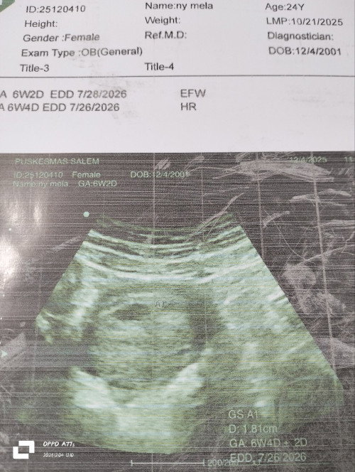 Minta sarannya dong bund,aku hpht 21okt,kpaksa USG pas tgl 4 kmaren d karnakn sakit pinggang.