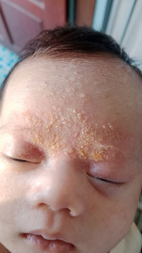 ทาอะไรจะหาย