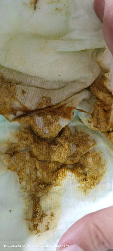 Mohon maaf agak jorok,, mau nanya bunda" Klo fases kaya gini tuhh ciri diare bukan yaaaah??